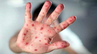 হামের উপসর্গে আরও ৫ শিশুর মৃত্যু