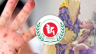 হামের উপসর্গে আরও ৫ জনের মৃত্যু