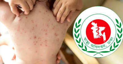 হাম ও উপসর্গে আরো ১১ শিশুর মৃত্যু