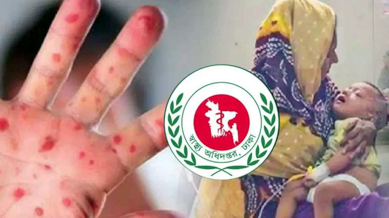 হামের উপসর্গে আরও ৭ শিশুর মৃত্যু